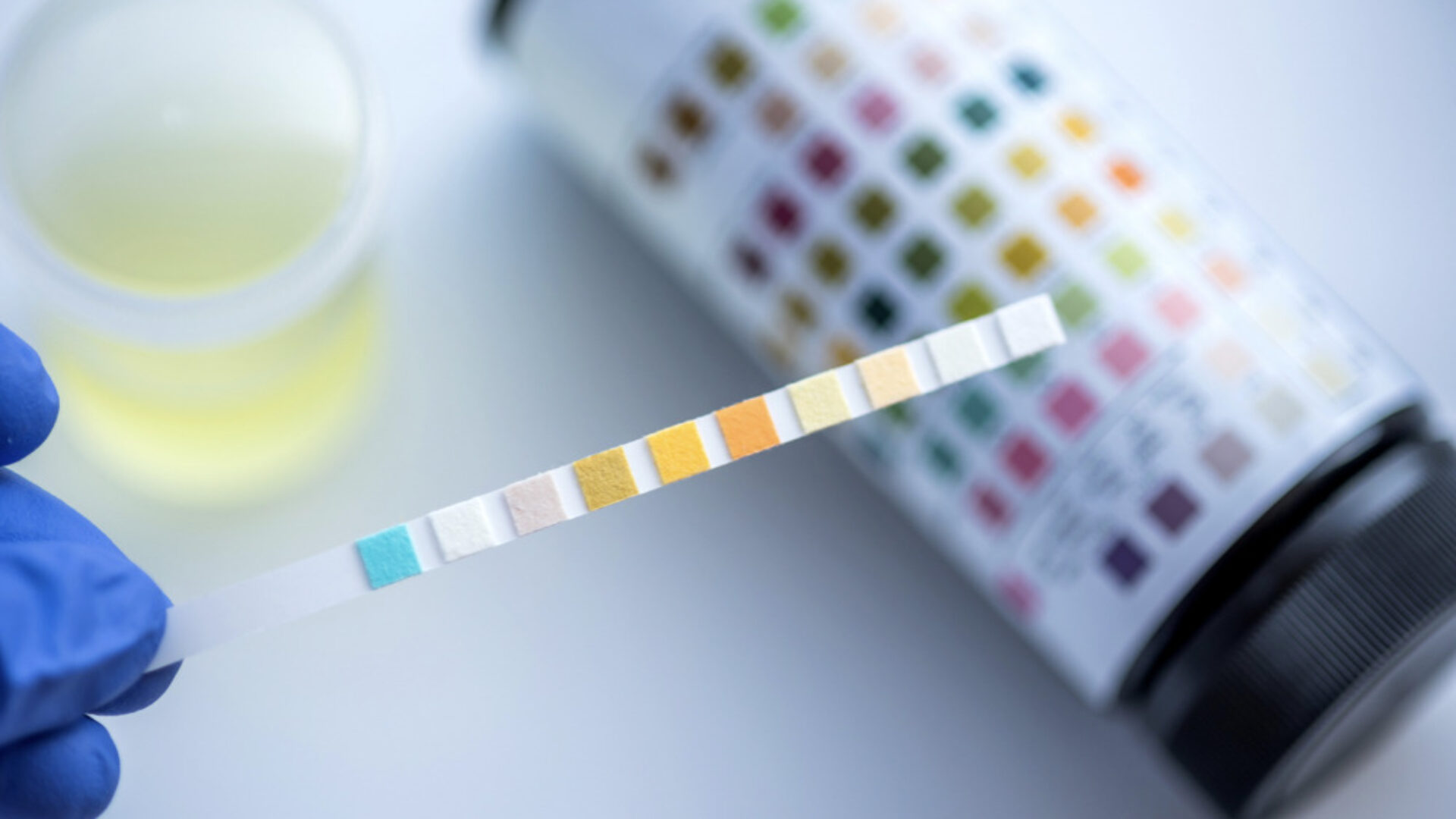 Understanding the 24 Hour Urinalysis