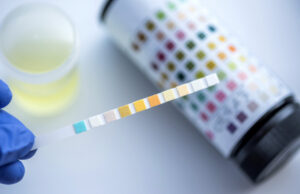 Read more about the article Understanding the 24 Hour Urinalysis