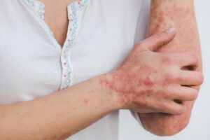 Read more about the article Natural Solutions to Psoriasis